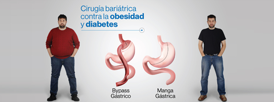 manga gastrico by pass gastrico directorio medico de cancun diabetes sobrepeso sergio verboonen mini bypass banda gastrica