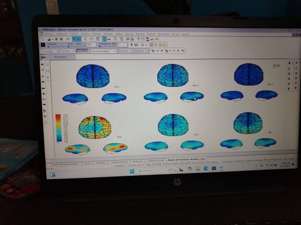 Electroencefalograma, Mapeo Cerebral cancun 3