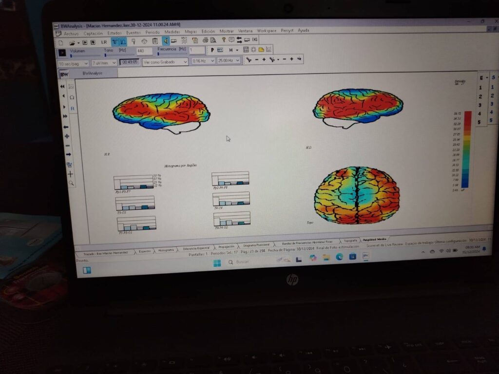 Electroencefalograma, Mapeo Cerebral cancun 2